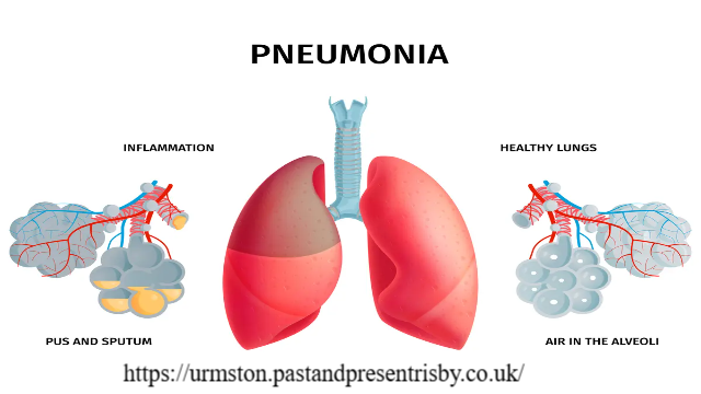 Mengungkap Risiko Pneumonia pada Lansia